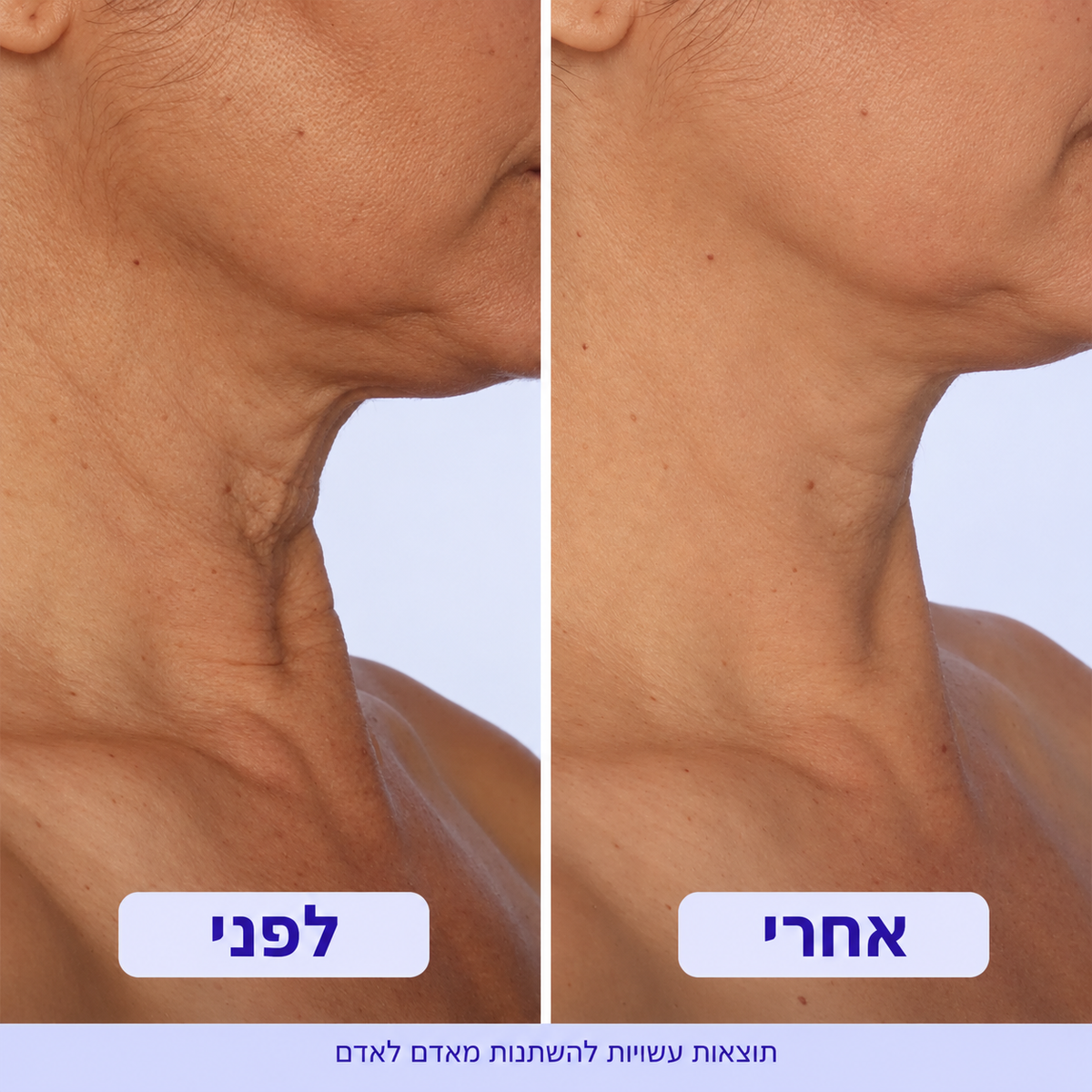 קרם למיצוק והרמת אזור הצוואר
